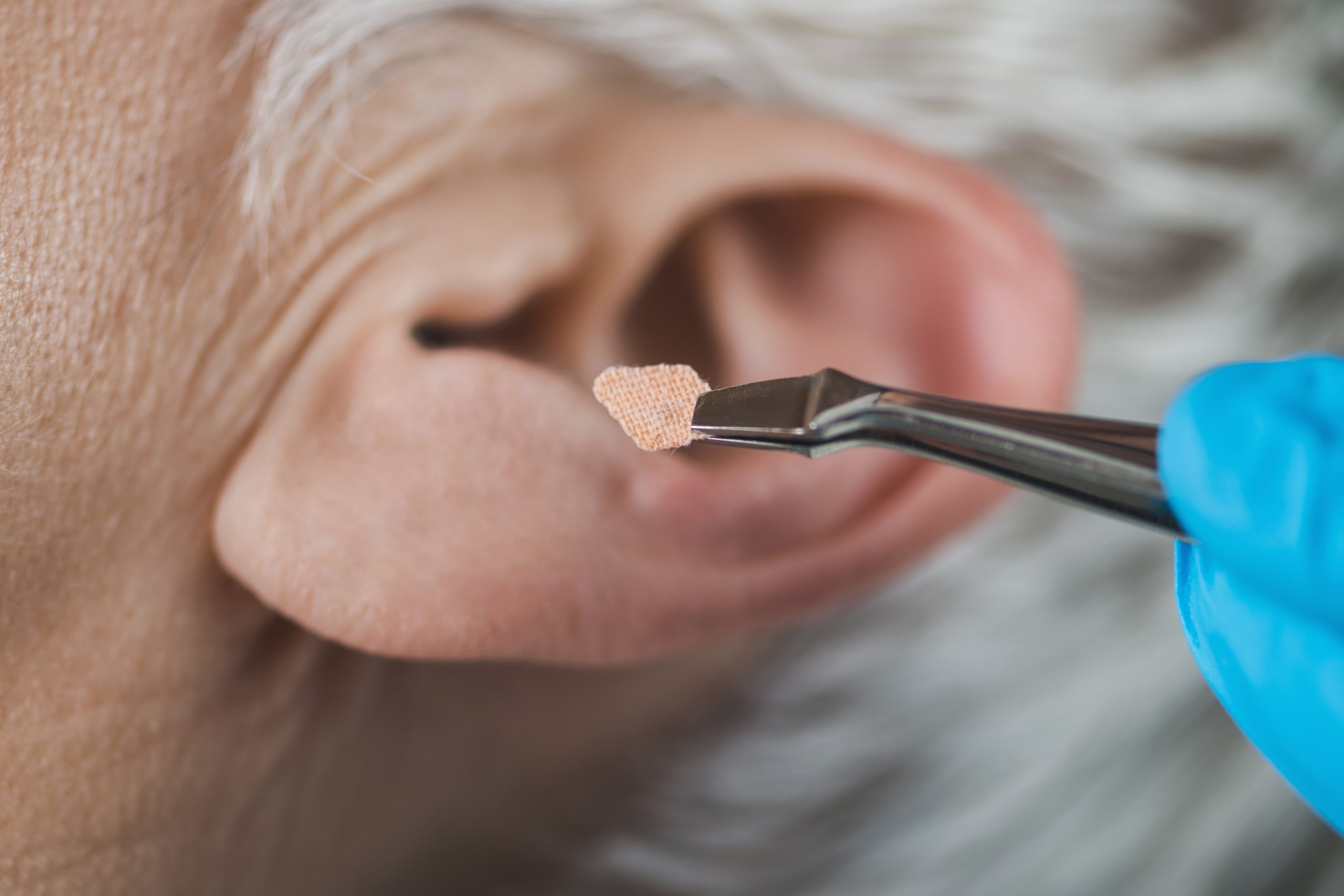 A close-up of a person’s ear with tweezers holding a small patch, while someone wearing a blue glove prepares to apply it near the ear—a scene reflecting wellness through integrative medicine.
